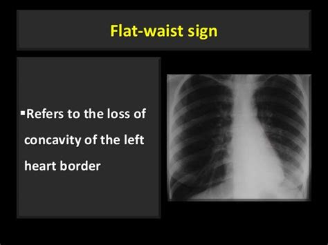 Deep Sulcus Sign Fallen Lung Sign Ct Angiogram Sign Flat Waist Sign