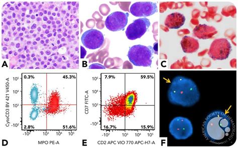 Acute Promyelocytic Leukemia Microgranular Variant