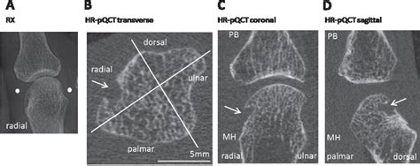 Figure 2 1 From High Resolution Peripheral Quantitative Computed