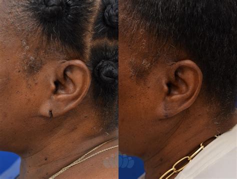 Otoplasty Earlobe Repair For Charlotte Concord Nc Dilworth