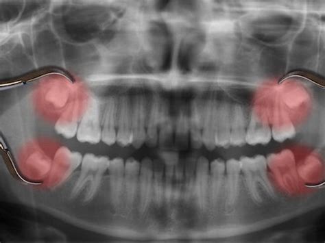 Muelas Del Juicio Todo Lo Que Debes Saber Cl Nica Dental Ramis Gand A