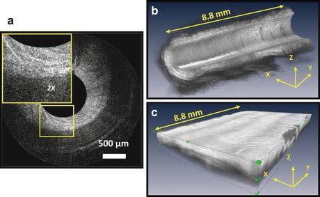 Endoscopic Optical Coherence Tomography Ento Key