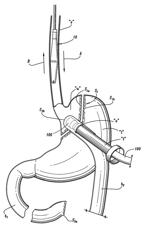 Apparatus And Method For Performing A Bypass Procedure In A Digestive System Eureka Patsnap