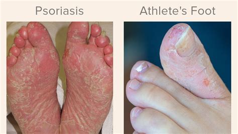 Can You Get Athlete S Foot On Only One Foot Online Emergencydentistry