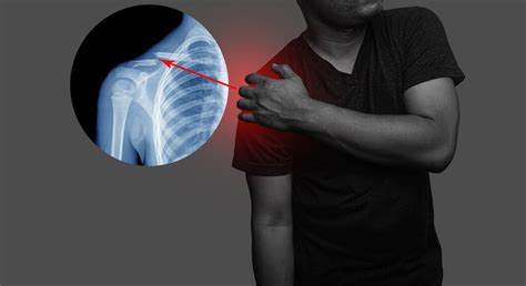 Premium Photo Close Up Shoulder And Clavicle Fracture Pain In A Man