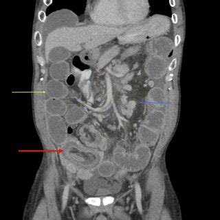 Abdominal CT Scan With Contrast Coronal View Revealing A Distended