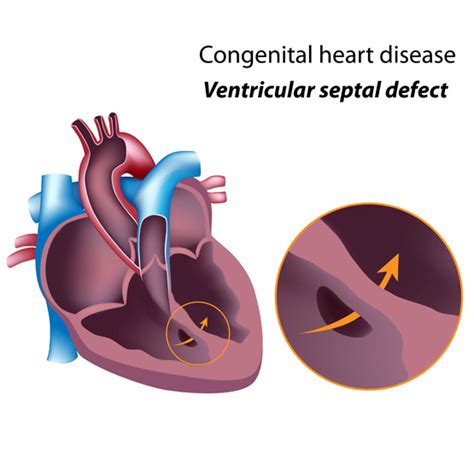 Ventricular Septal Defect Vsd Hole In The Heart Diagnosed By An Echo