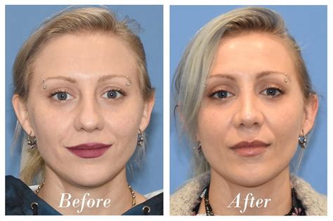 Rhinoplasty Before And After 04 Vip