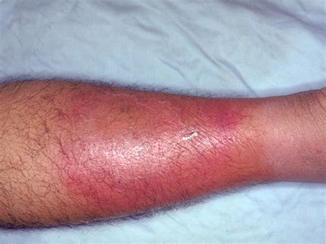 Cellulitis Treatment And Management Hills Physiotherapy