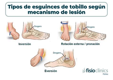 Cómo se tratan los Esguinces de tobillo FisioClinics Palma