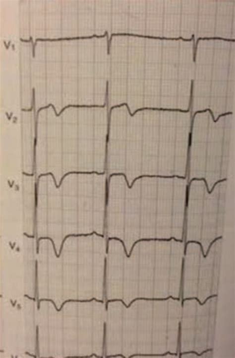 Intermittent Left Bundle Branch Block An Overlooked Cause Of