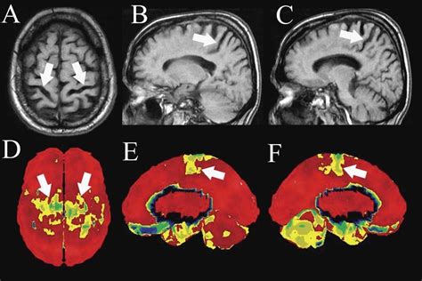 Brain MRI showing severe bilateral atrophy localized in the rolandic ...