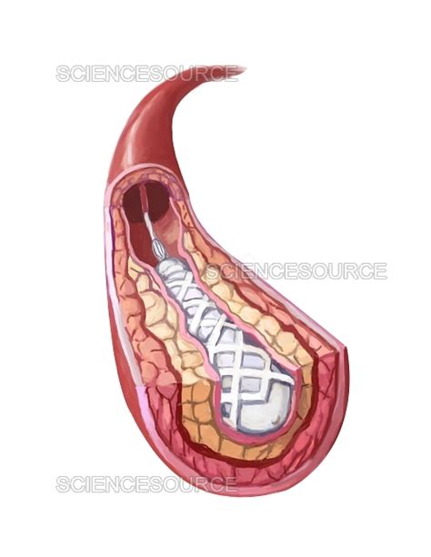 Photograph Clogged Artery Stent Science Source Images