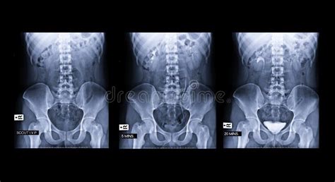 Ivp Intravenous Pyelogram Ten Minutes After Administration Of