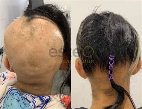 PRP Hair Loss Treatment | PRP Therapy for Hair Restoration - Este