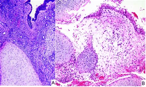 Nasal Chondromesenchymal Hamartoma A This Tumor Demonstrating A