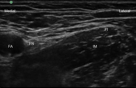 Fascia Iliaca Compartment Block Bja Education