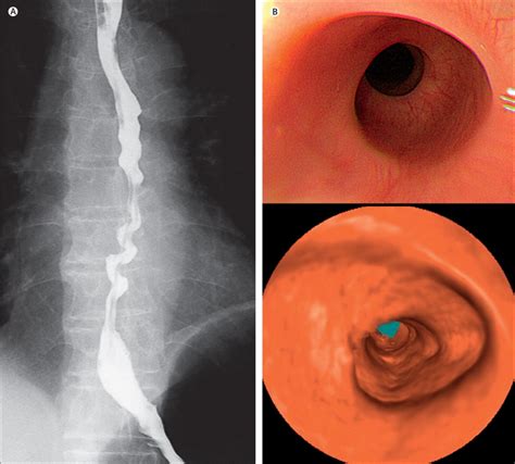 Corkscrew Oesophagus On Virtual Endoscopy The Lancet