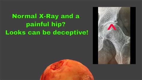 Painful Hip And A Normal X Ray Looks Can Be Deceptive Youtube