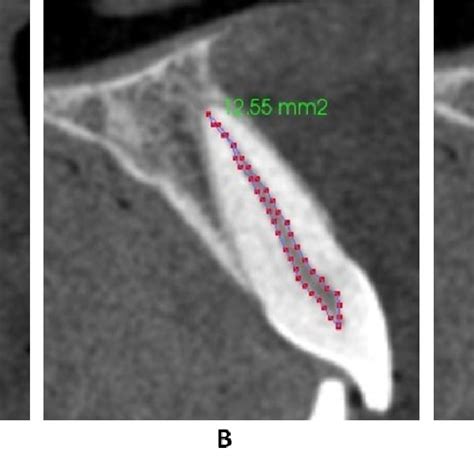 Pdf Relationship Between Pulp Tooth Area Ratio And Chronological Age Using Cone Beam Computed