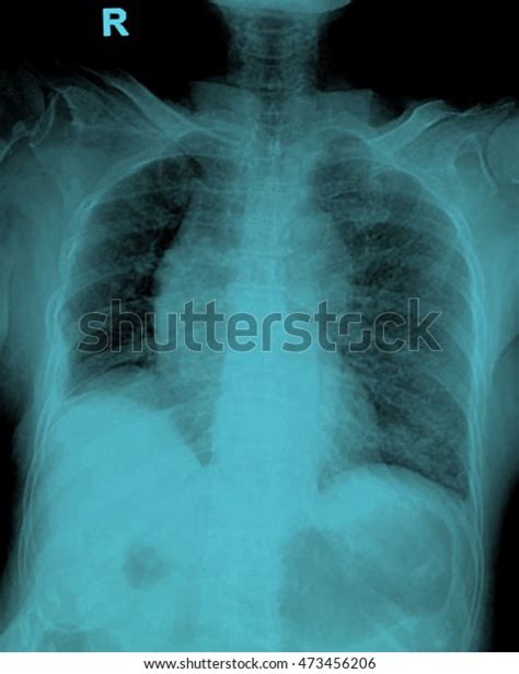 Film Chest Xray Show Alveolar Infiltrate Stock Photo