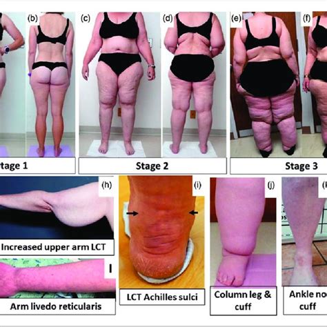 Stages and features of lipedema. (a) to (f): Front and back pictures of... | Download Scientific ...