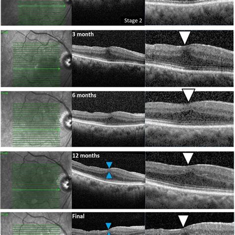 The Spectral Domain Optical Coherence Tomography SD OCT Images Of Two