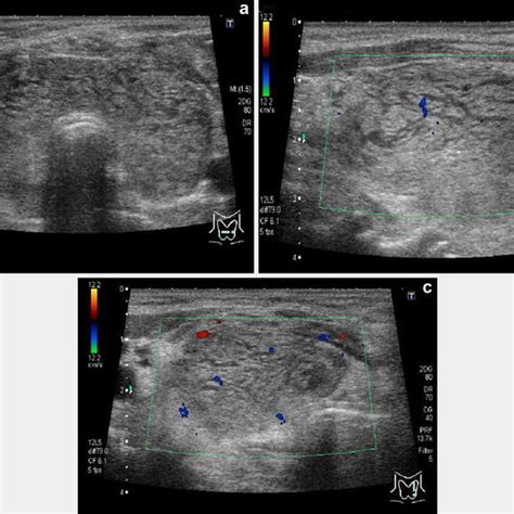 Thyroid Ultrasonography After Admission A Transverse Section Of The