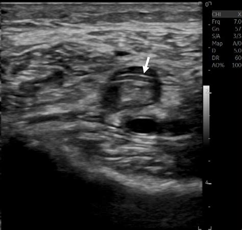 DVT in the left popliteal vein. | Download Scientific Diagram