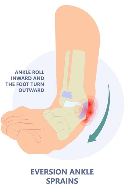 What Is A High Ankle Sprain Zamst Blog