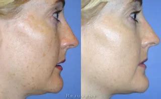 Aging Skin Photos Rejuvent Medical Spa Scottsdale