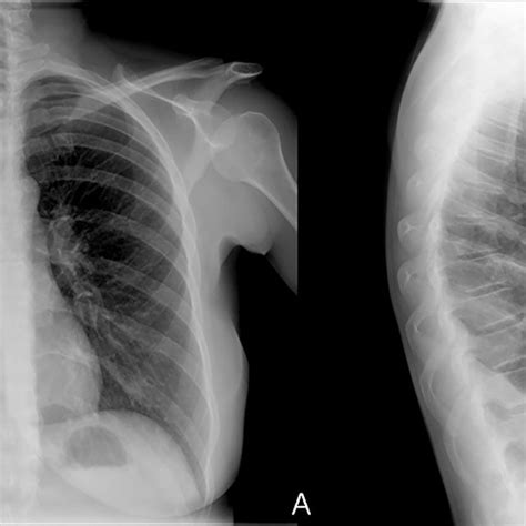 Chest X Ray On Posterior Anterior A And Lateral B Views