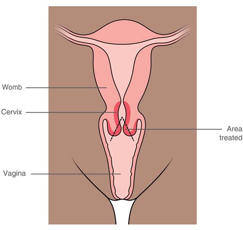 Vagina Cervix Telegraph