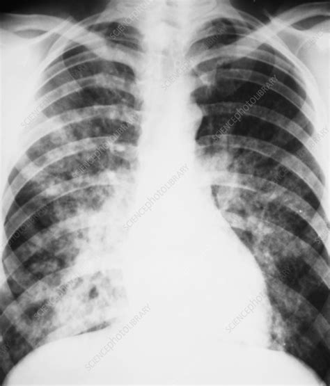 Pneumonia X Ray Stock Image C013 9383 Science Photo Library