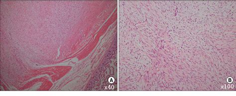 Figure From A Case Of Ileal Mesenteric Desmoid Tumor Resected By