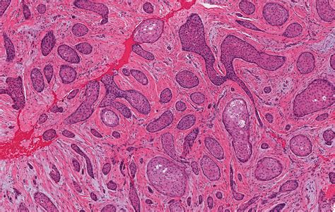 Pathology Outlines Who Classification