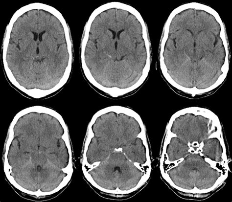 Axial Sections From Noncontrast Head CT Demonstrating Hyperdense