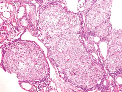 A Photomicrograph Shows The Odontogenic Epithelium Arranged In Whorls