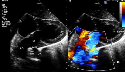 Echocardiography 2d And Color Doppler Subcostal View Showing A