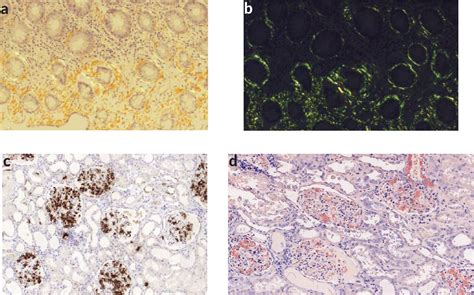 Figure 3 From Advanced Systemic Amyloidosis Secondary To Metastatic Renal Cell Carcinoma