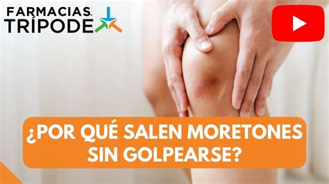 Por Qu Salen Moretones Sin Golpearse Youtube