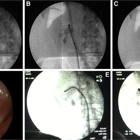 Lawson Retrograde Endoscopic Assisted Access A Retrograde Pyelogram