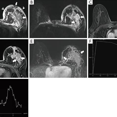 A 44 Year Old Woman With Histologically Proven Plasma Cell Mastitis