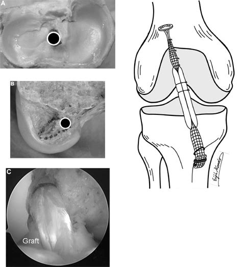 Prospective Clinical Comparisons Of Anatomic Double Bundle Versus