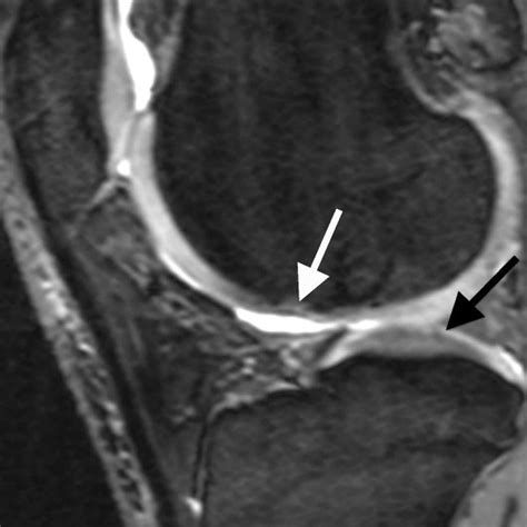 Sagittal Pd Weighted Tse Mri Of A 41 Year Old Male A Defect Of More