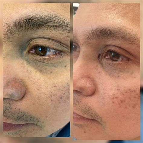 Vad är Nevus Of Ota Ambers® Skönhet Och Laserklinik I Göteborg