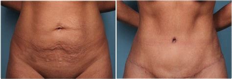 Abdominoplasty Before And After What You Need To Know Bellezie