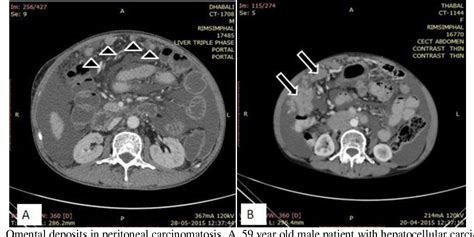 Figure 15 From Peritoneal Carcinomatosis Pictorial Review Of Computed