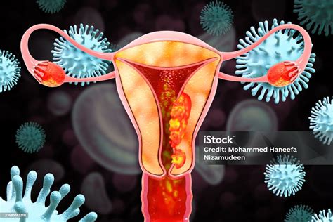 Female Reproductive System Diseases Uterus Cancer And Endometrial