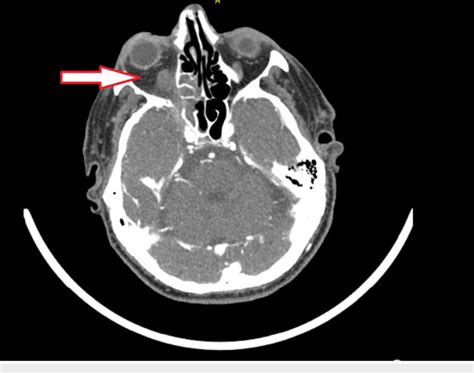 Ct Head Concerning For Invasive Fungal Sinusitis With Abnormal Soft Download Scientific Diagram